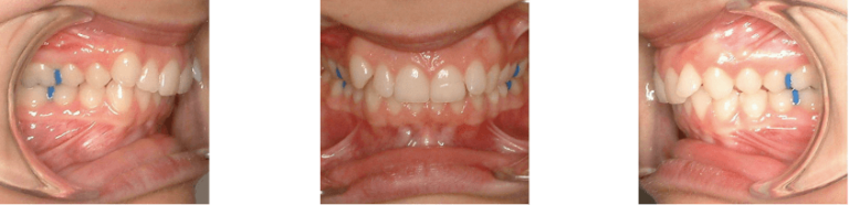 class 2 malocclusion before after