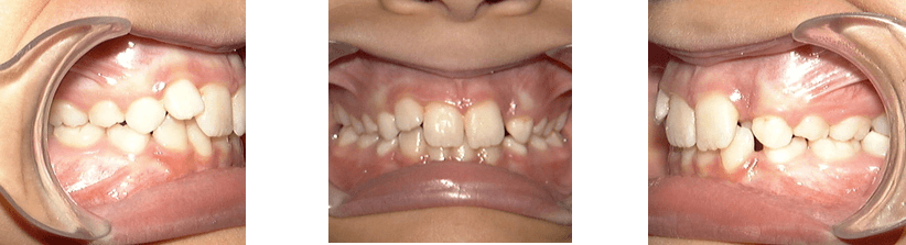 How Do You Fix an Overbite? - Burke & Beckstrom Orthodontics