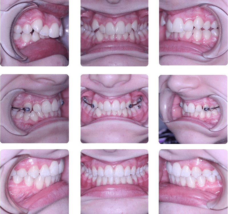 Braces were used to finalize occlusion after CMA