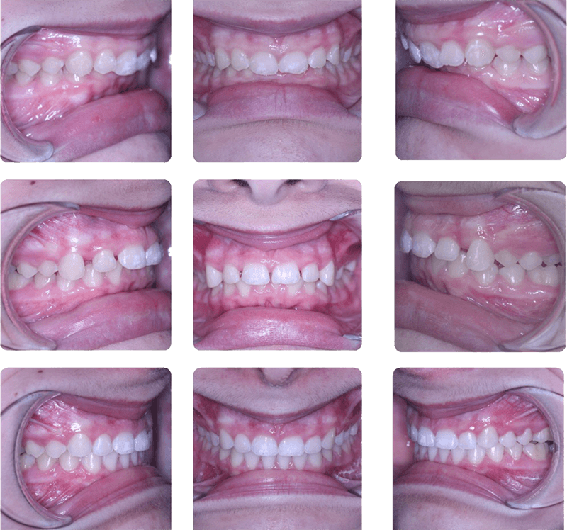 Invisalign was used to finalize occlusion after CMA