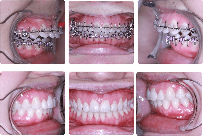 CL II malocclusion treated with orthodontics and surgery to advance of lower jaw