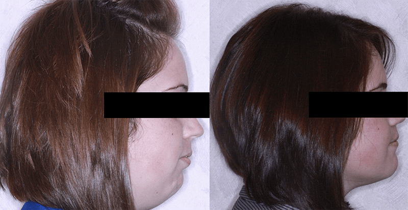 CL II malocclusion treated with orthodontics and surgery to advance of lower jaw