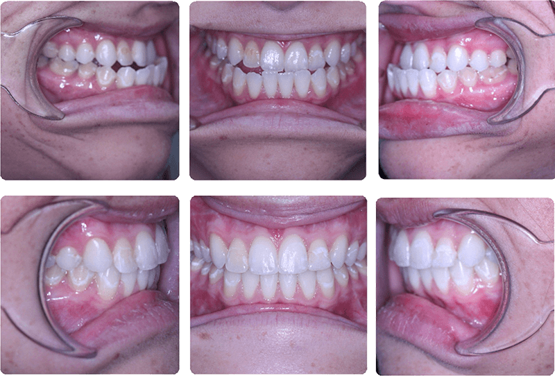 CL III malocclusion treated with orthodontics and surgery to advance upper jaw