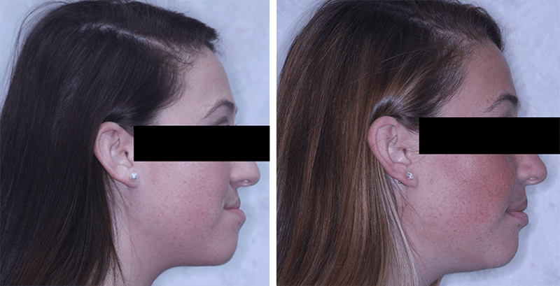 CL III malocclusion treated with orthodontics and surgery to advance upper jaw