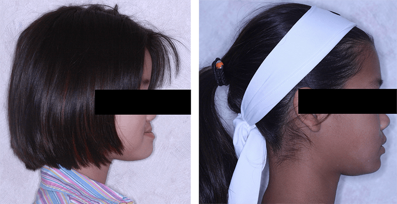 Class III malocclusion treated with protraction headgear