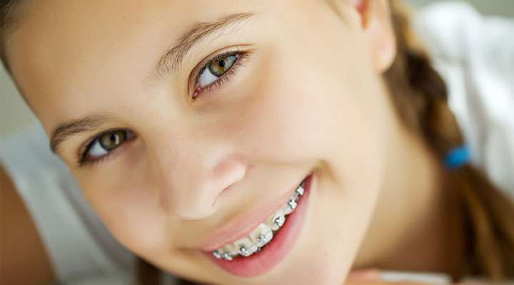 Braces