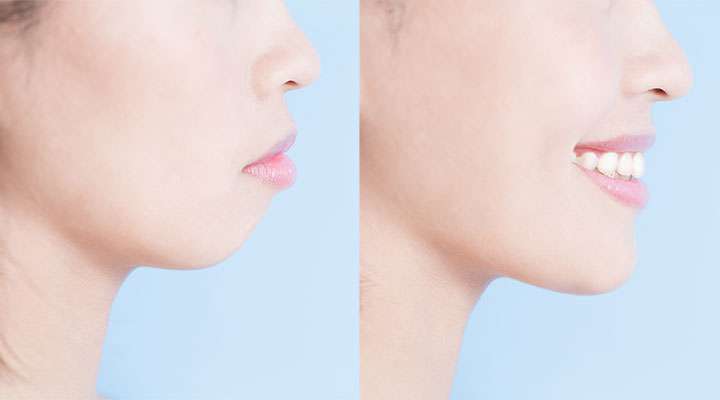Jaw Surgery