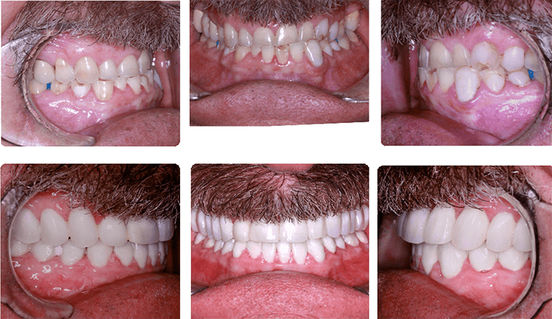 Needed orthodontic treatment to open vertical to have clearance for crowns
