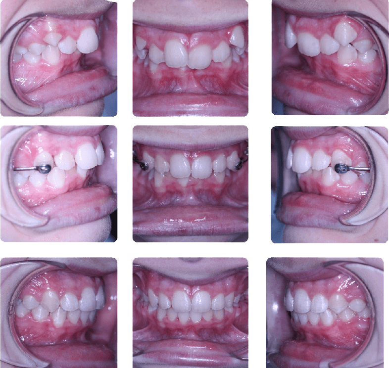 Severe Class II deep bite malocclusion treated with Carriere Motion Appliance and braces