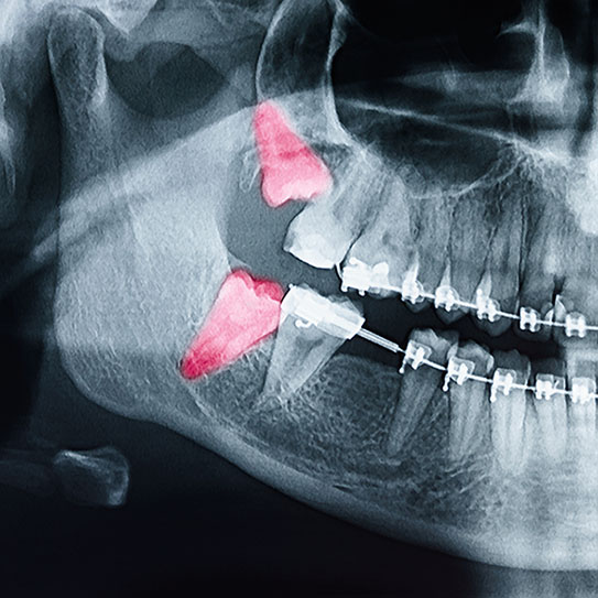 Orthodontic Treatment and Wisdom Teeth